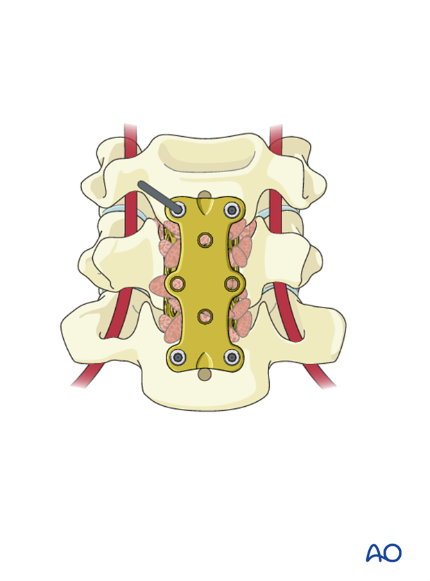 anterior plating