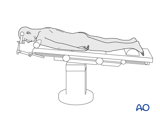 cervical spine posterior fixation