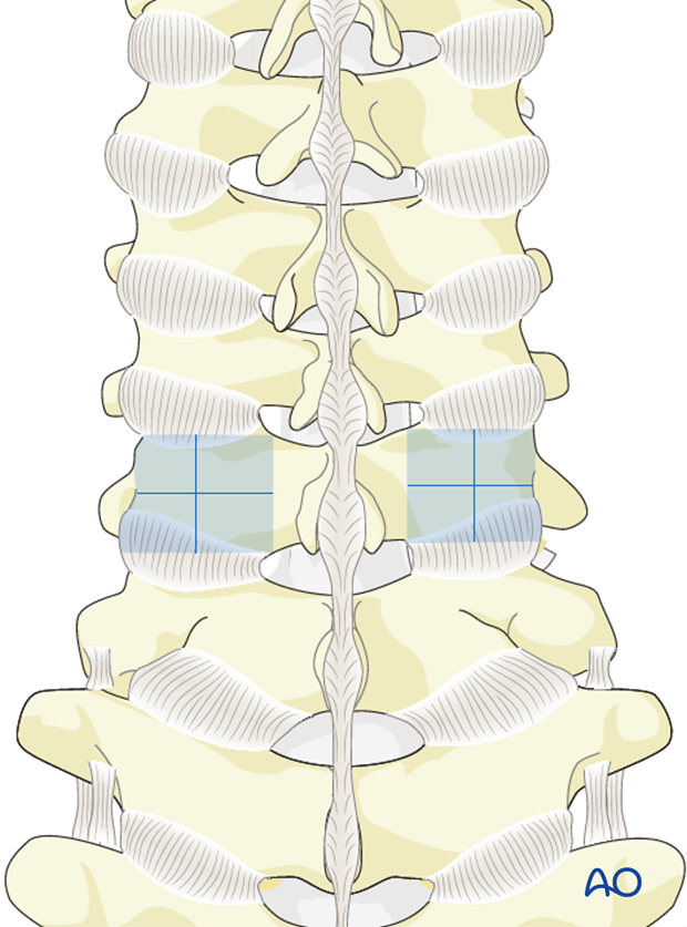 Using anatomical landmarks to identify screw entry points in lateral mass screw insertion magerl technique