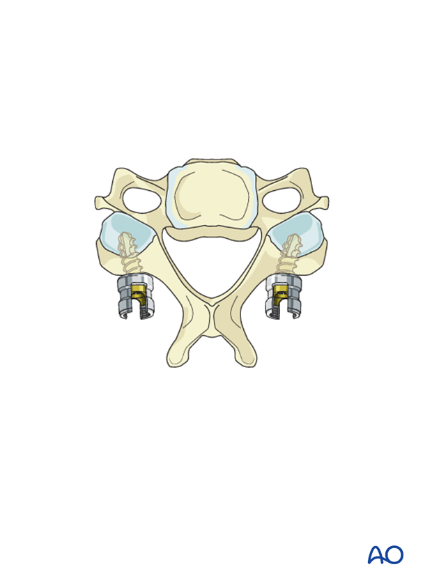 Use of monocortical screws in lateral mass screw insertion magerl technique