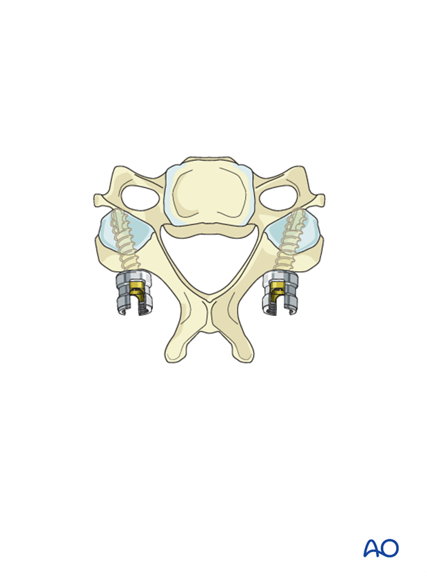 Use of bicortical screws in lateral mass screw insertion magerl technique