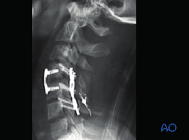 postoperative deformities