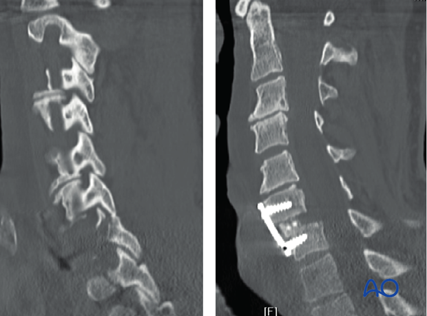 postoperative deformities