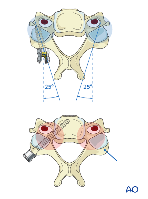 surgical compliations