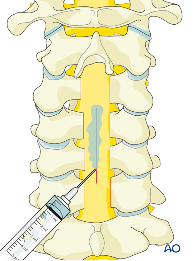 surgical compliations