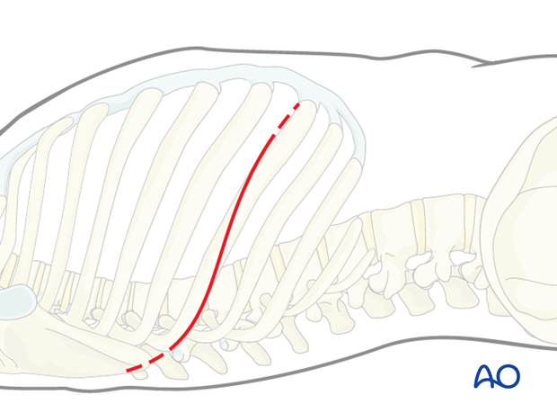 Thoracic and lumbar fractures: Right sided thoracotomy (T3-T10)