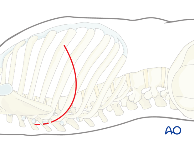 Thoracic and lumbar fractures: Right sided thoracotomy (T3-T10)