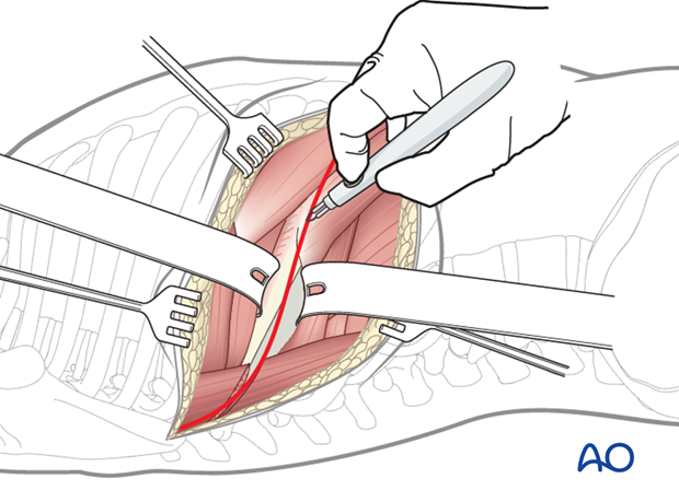 Thoracic and lumbar fractures: Right sided thoracotomy (T3-T10)