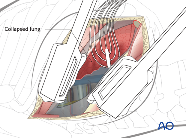 Thoracic and lumbar fractures: Right sided thoracotomy (T3-T10)