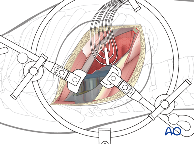 Thoracic and lumbar fractures: Right sided thoracotomy (T3-T10)