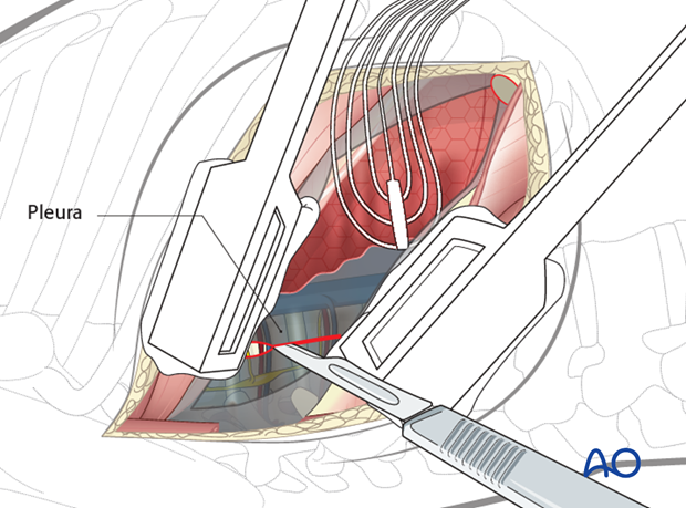 Thoracic and lumbar fractures: Right sided thoracotomy (T3-T10)