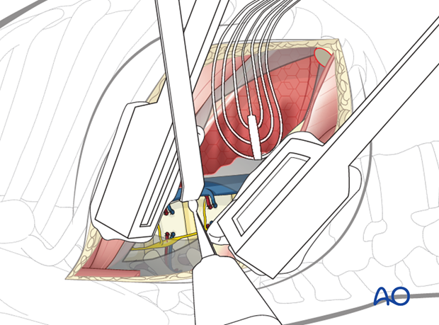 Thoracic and lumbar fractures: Right sided thoracotomy (T3-T10)