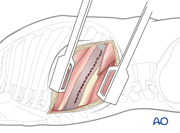 Thoracic and lumbar fractures: Right sided thoracotomy (T3-T10)