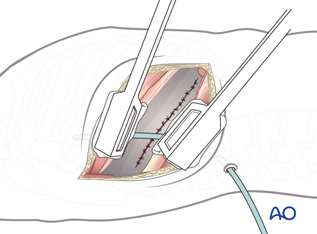 Thoracic and lumbar fractures: Right sided thoracotomy (T3-T10)