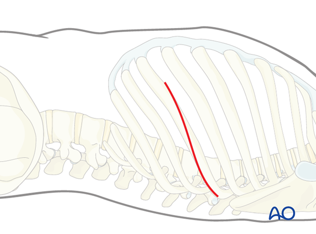 Left sided thoracotomy (T3-L1/2)