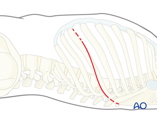 Thoracic and lumbar fractures: Left sided thoracotomy (T3-L1/2)