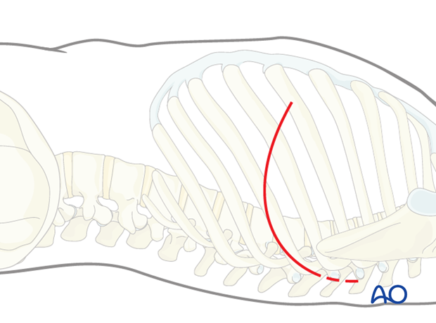 Thoracic and lumbar fractures: Left sided thoracotomy (T3-L1/2)