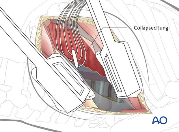 Thoracic and lumbar fractures: Left sided thoracolumbar junction approach (T10-L2) 