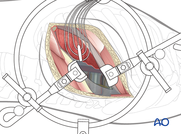 Thoracic and lumbar fractures: Left sided thoracotomy (T3-L1/2)