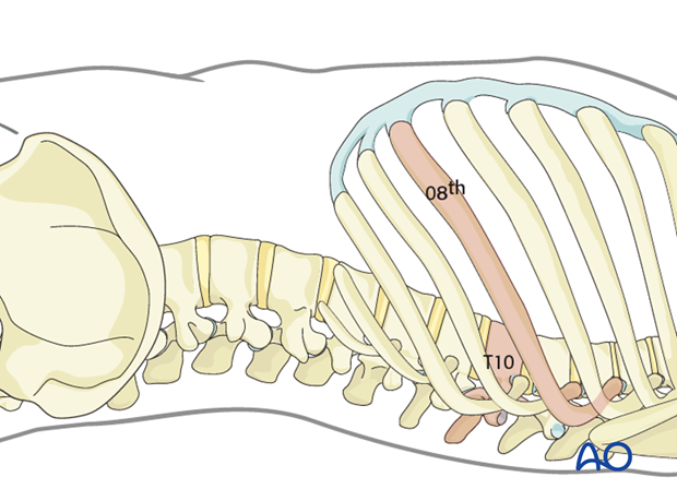 Thoracic and lumbar fractures: Left sided thoracolumbar junction approach (T10-L2) 