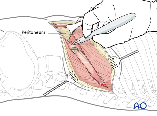 Thoracic and lumbar fractures: Left sided thoracolumbar junction approach (T10-L2) 