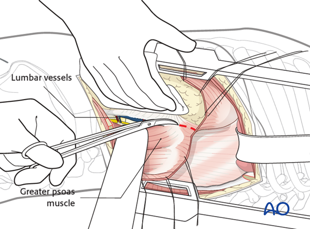 Thoracic and lumbar fractures: Left sided thoracolumbar junction approach (T10-L2) 