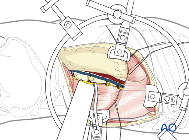 Thoracic and lumbar fractures: Left sided thoracolumbar junction approach (T10-L2) 