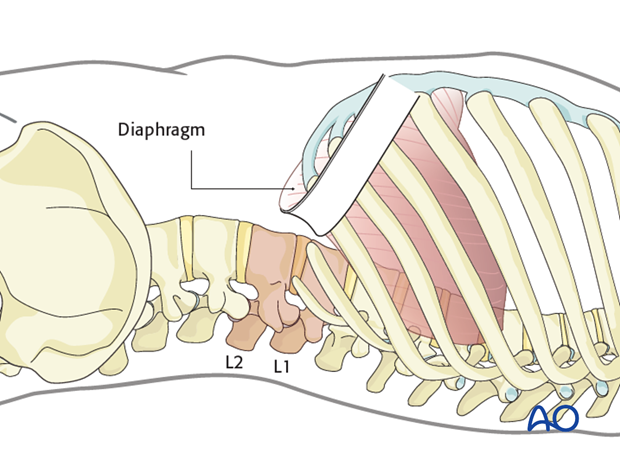 Thoracic and lumbar fractures: Left sided thoracolumbar junction approach (T10-L2) 