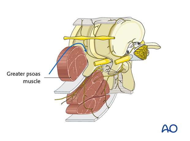 Thoracic and lumbar fractures: Minimally invasive lumbotomy (L2-L4)