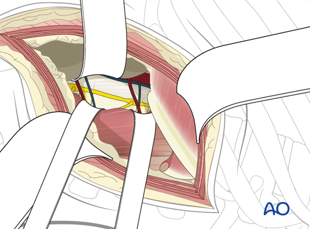 Thoracic and lumbar fractures: Left sided thoracolumbar junction approach (T10-L2) 