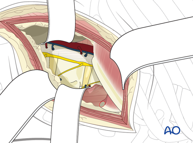 Thoracic and lumbar fractures: Left sided thoracolumbar junction approach (T10-L2) 