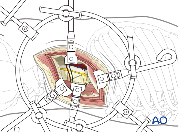 Thoracic and lumbar fractures: Left sided thoracolumbar junction approach (T10-L2) 