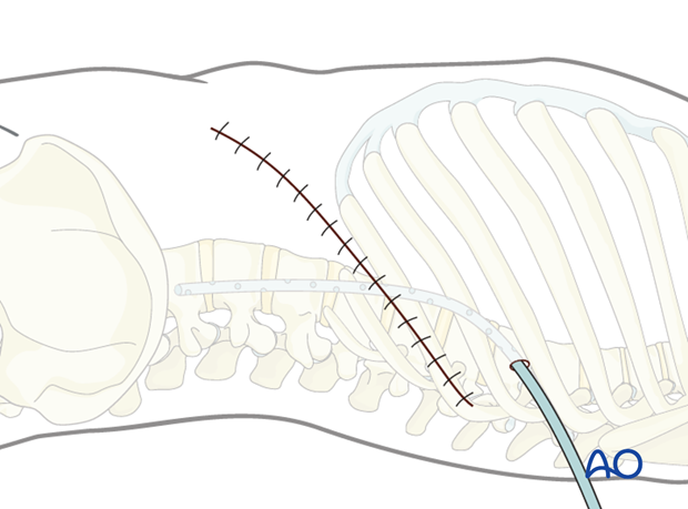 Thoracic and lumbar fractures: Left sided thoracolumbar junction approach (T10-L2) 