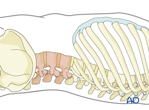 Thoracic and lumbar fractures: Lumbotomy (L1-L4)