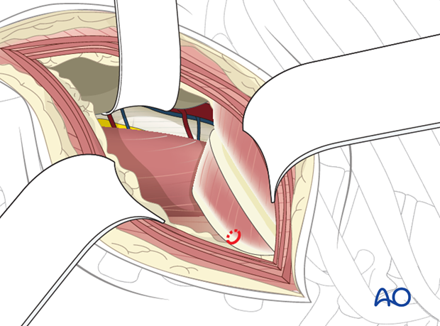 Thoracic and lumbar fractures: Lumbotomy (L1-L4)