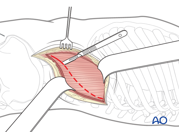 Thoracic and lumbar fractures: Lumbotomy (L1-L4)