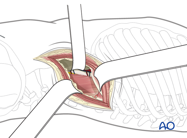 Thoracic and lumbar fractures: Lumbotomy (L1-L4)