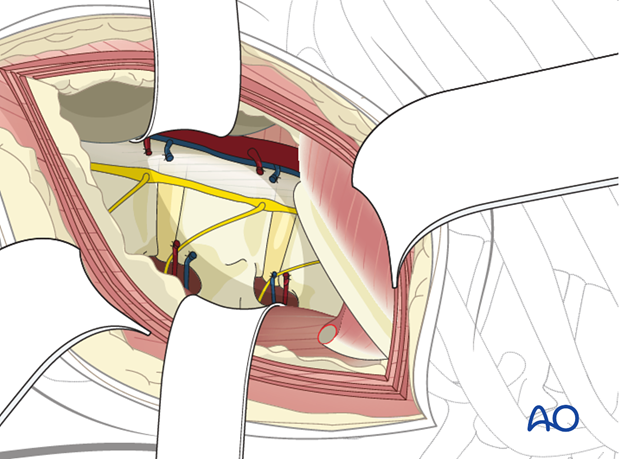 Thoracic and lumbar fractures: Lumbotomy (L1-L4)