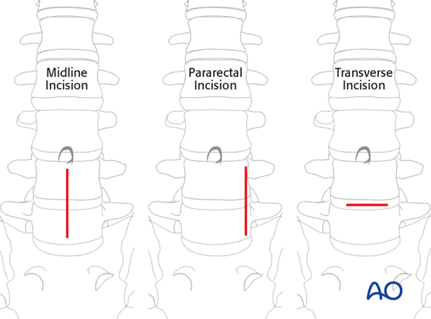 Thoracic and lumbar fractures: Mini open retroperitoneal approach (L4-S1)