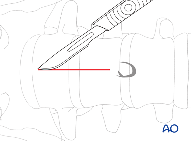 Mini open retroperitoneal approach (L4-S1)