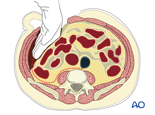 Thoracic and lumbar fractures: Mini open retroperitoneal approach (L4-S1)