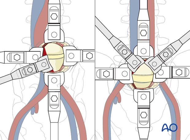 Thoracic and lumbar fractures: Mini open retroperitoneal approach (L4-S1)