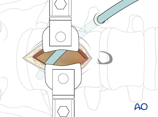 Thoracic and lumbar fractures: Mini open retroperitoneal approach (L4-S1)