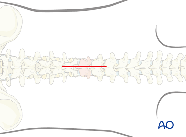 Posterior open approach - midline approach (T1-S1)