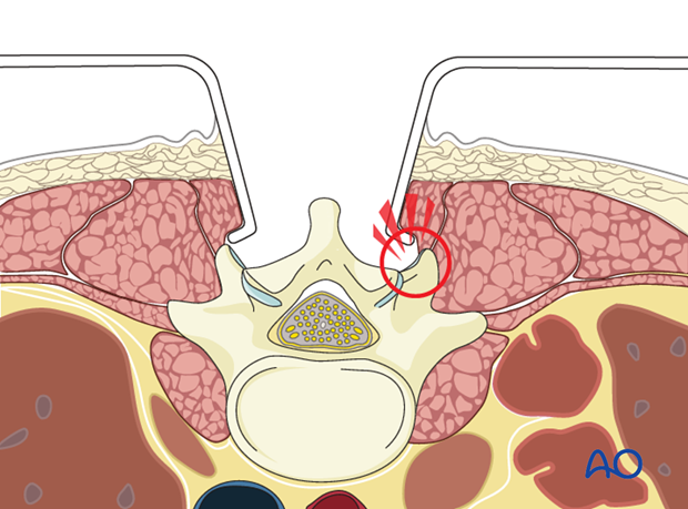 posterior open approach   midline approach t1 s1