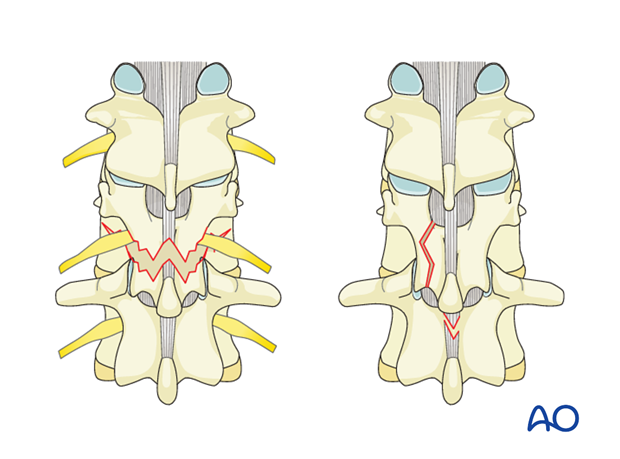 posterior open approach   midline approach t1 s1