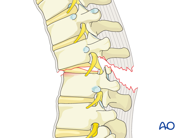 posterior open approach   midline approach t1 s1