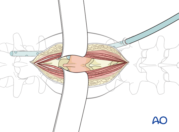 posterior open approach   midline approach t1 s1