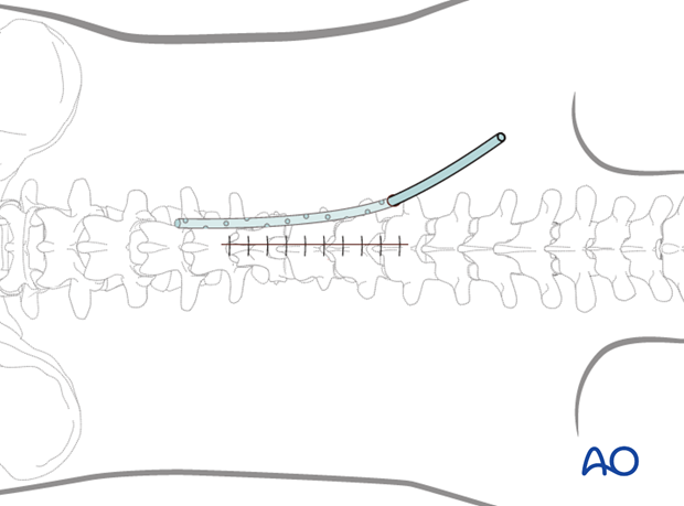 posterior open approach   midline approach t1 s1