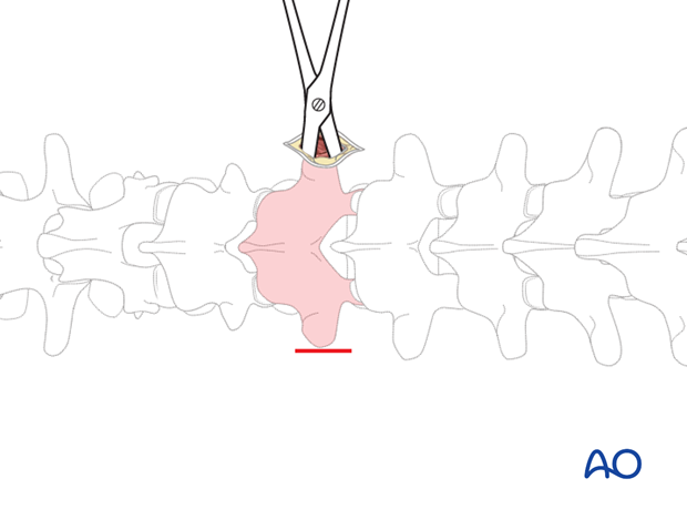 percutaneous posterior approach for pedicle screw placement